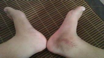 脚骨折了吃哈密瓜,哈密瓜助力营养恢复与康复